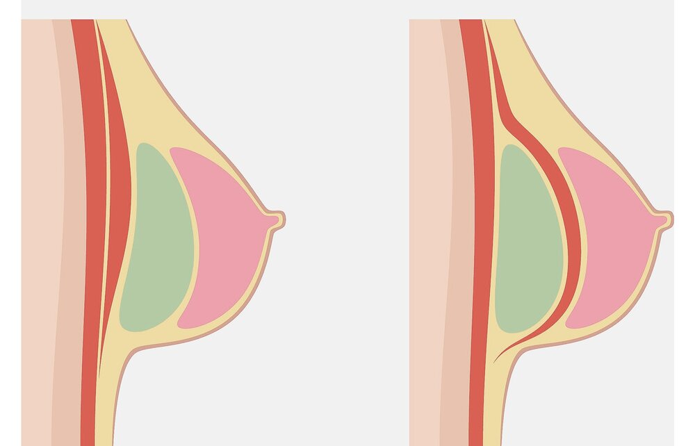 Breast Implant Position: Above or Below the Muscle? - Imagine Plastic  Surgery