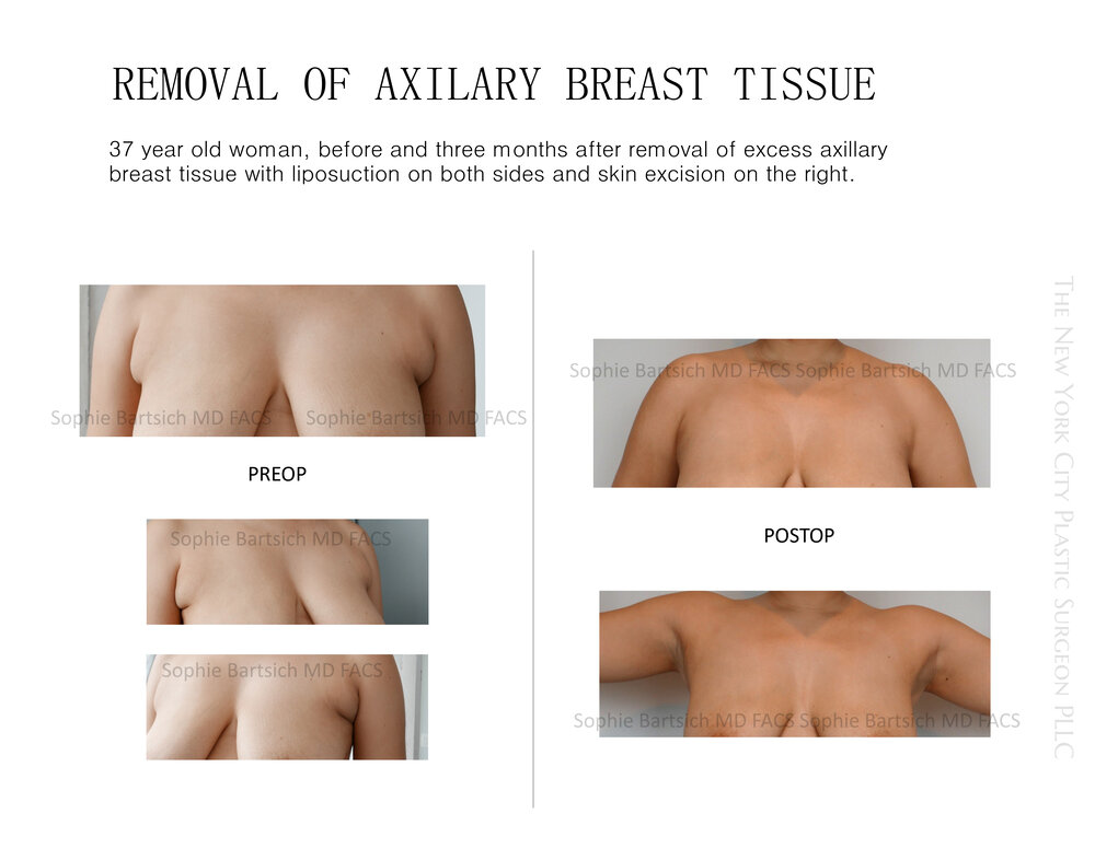 Singapore's Complete Guide on Armpit Fat & Axillary Accessory Breasts Tissue