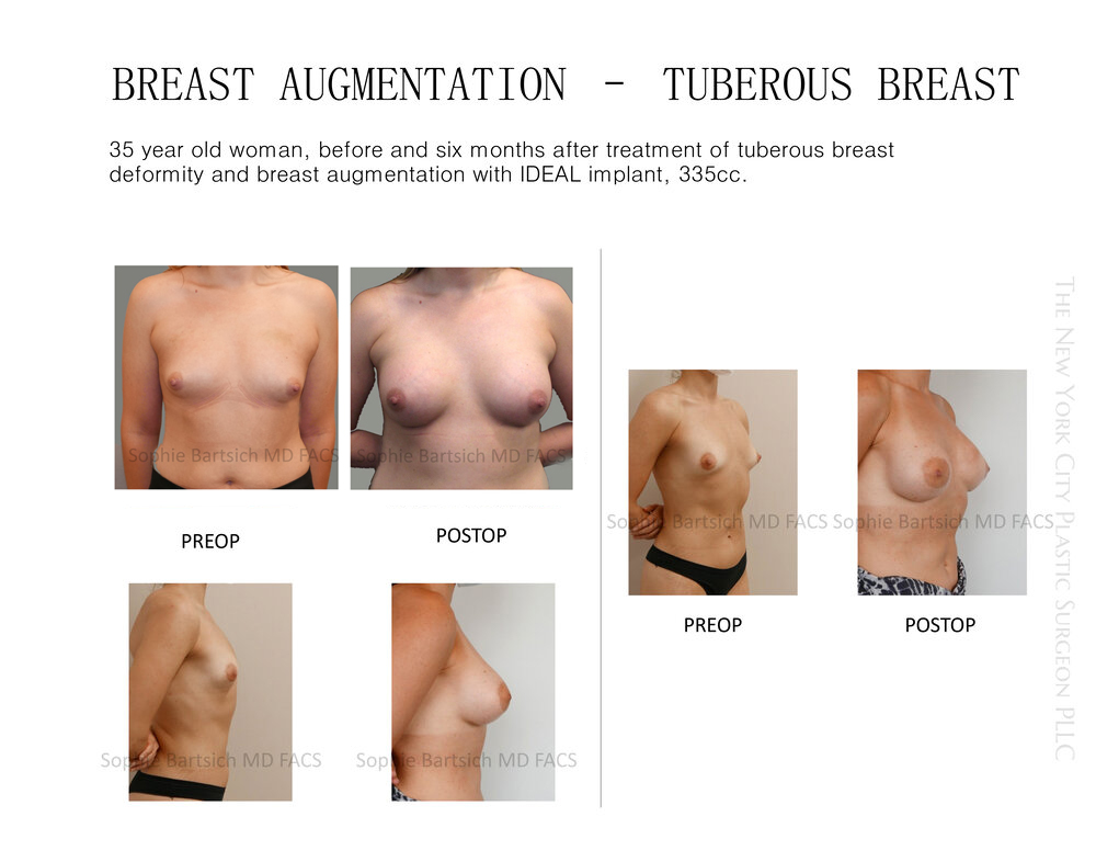 Tubular Breast Release, Tuberous Breasts, Augmentation