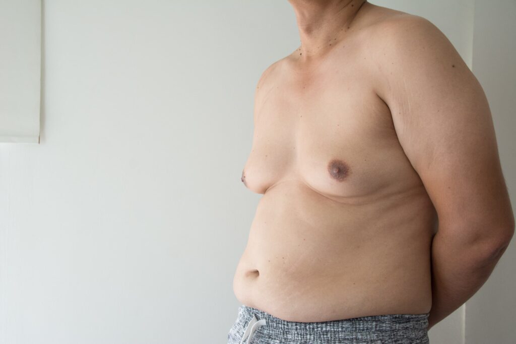 Don't Be Such A Boob! -What is Gynecomastia and Can It Be Treated?