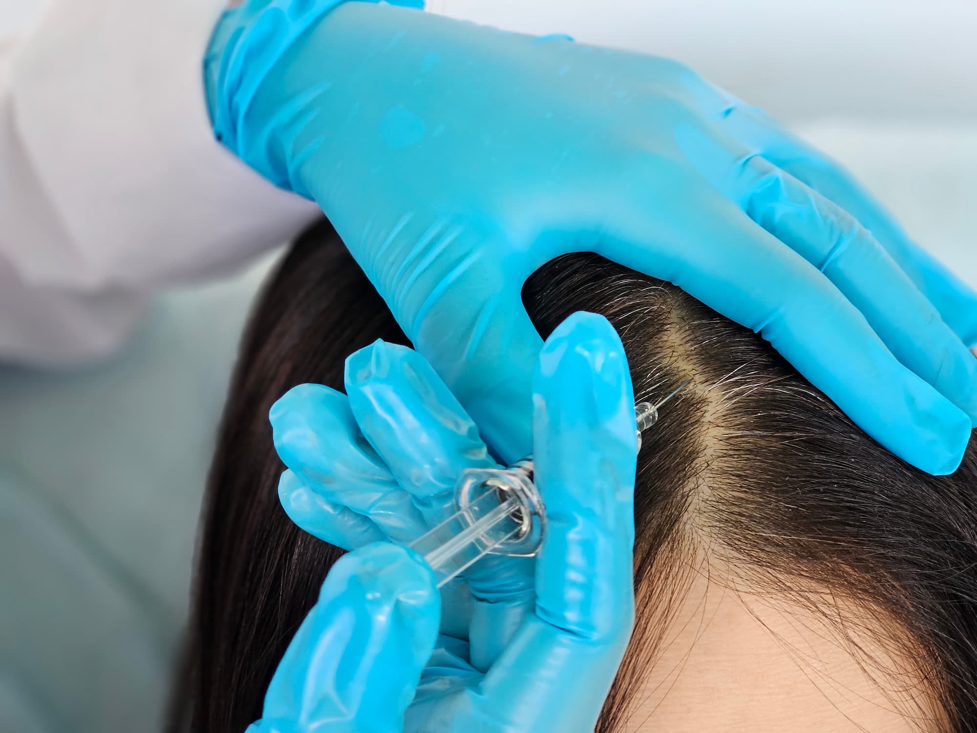 Syringe being injected into scalp for PRP treatment