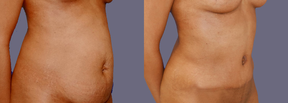 Before and After of Tummy Reduction